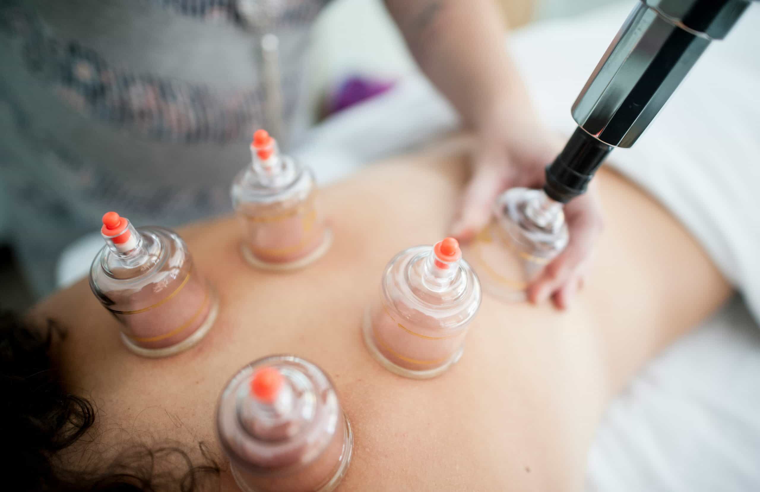 cupping mild-hyperbaric-oxygen-therapy